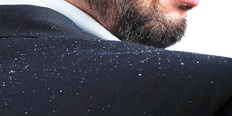 How Men Can Get Rid of Dandruff & Flakes In Their Hair