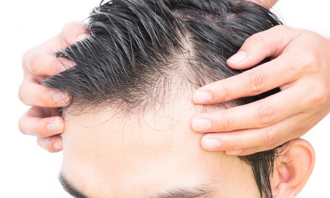 Bernstein Medical  Center for Hair Restoration  Case Studies on Hair  Restoration A 25yearold male presents with gradual thinning since age 16  Diffuse thinning that starts at an early age and